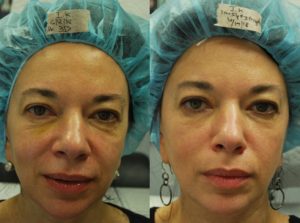 Morpheus 8 InMode: Фракционная RF-технология для лифтинга и омоложения кожи